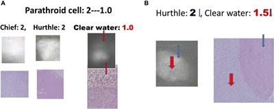 Why does diseased parathyroid appear weak or heterogenous intensity during intraoperative near-infrared autofluorescence?